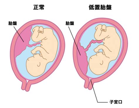 低位胎盤|低置胎盤の原因、症状、妊娠や胎児への影響 治療や予防は可。